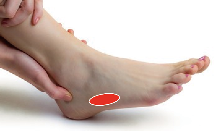 歩けない治らない腓骨筋腱炎の体験談 ランニングで発生した足首の外側（くるぶし下）痛みの原因と経過