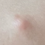 実際のしこりの写真