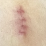 抜糸直後は赤みがあった