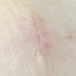 縫った糸の痕が目立たなくなり線状になってきた