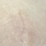 赤みもかなり消えた